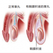 腹腔镜鞘膜积液微创修复手术——有效治疗鞘膜